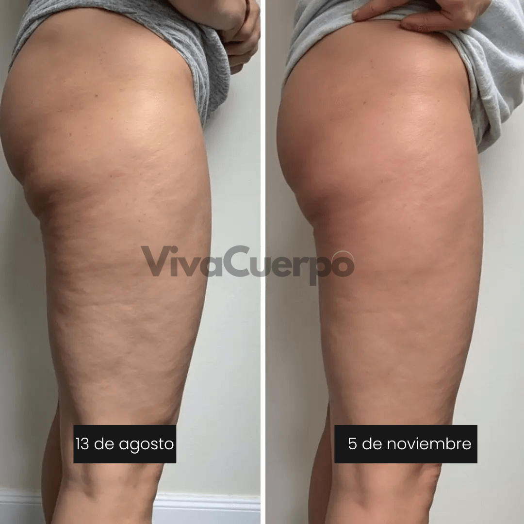 VivaCuerpo — Celulitis