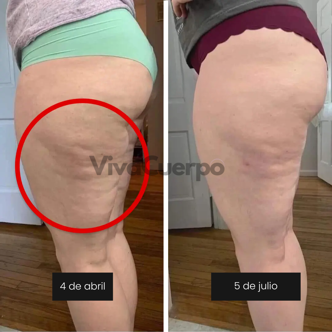 VivaCuerpo — Celulitis