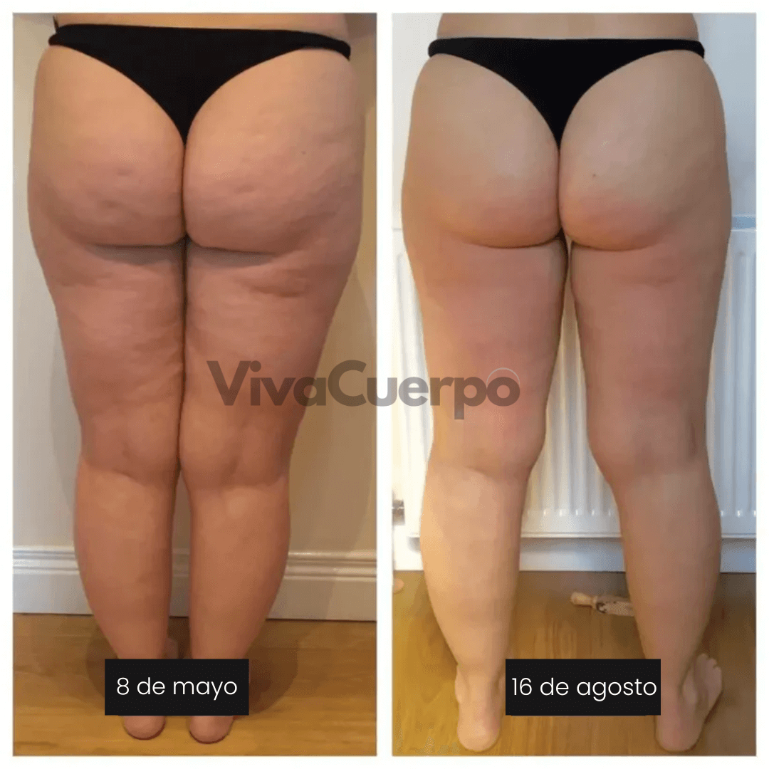 VivaCuerpo — Celulitis